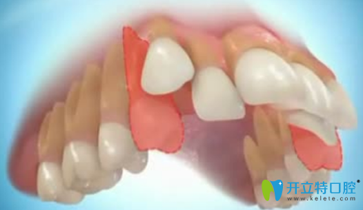 整牙是不是都需要拔牙