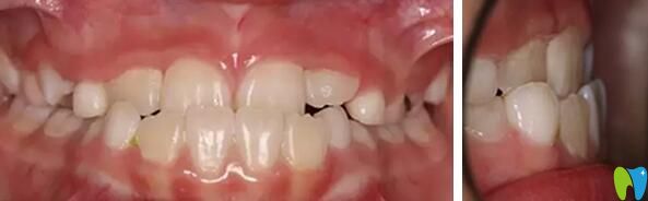 武漢健齒口腔MRC矯正牙齒前 武漢健齒口腔MRC矯正牙齒前