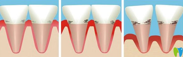 牙周病引起牙齒松動的治療辦法