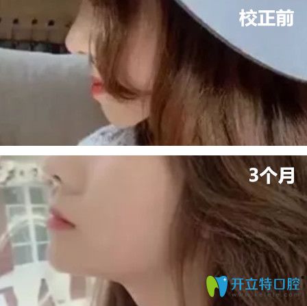 去杭州拜博口腔做地包天矯正前后臉型變化圖展示 去杭州拜博口腔做地包天矯正前后臉型變化圖展示