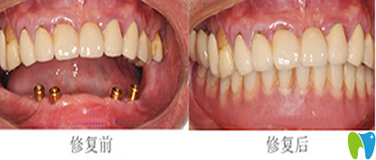 鄭州精益口腔種植牙前后效果對比圖