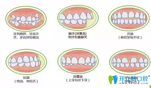 深度揭秘：在做牙齒矯正之前，你不得不了解的17個問題