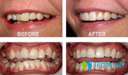精益口腔門診部牙齒矯正效果對比圖