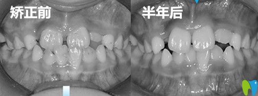 成都金琴口腔兒子地包天矯正前后<span style=