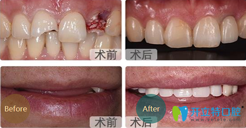 成都亞非口腔種植牙前后效果對(duì)比圖