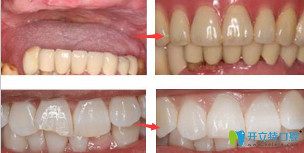 清華陽光口腔陳清華醫(yī)生看牙效果