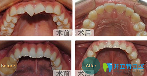 成都亞非牙科牙齒矯正前后效果對(duì)比圖