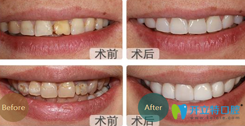成都亞非口腔牙齒美白前后效果對(duì)比圖
