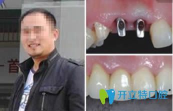 成都唐牙科種植牙真人案例圖