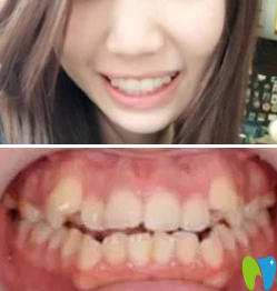 我在鄭州精益口腔做的牙齒矯正價格挺實(shí)惠 來看前后對比照