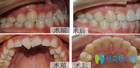成都亞非牙科黃心建牙齒矯正前后效果對(duì)比圖