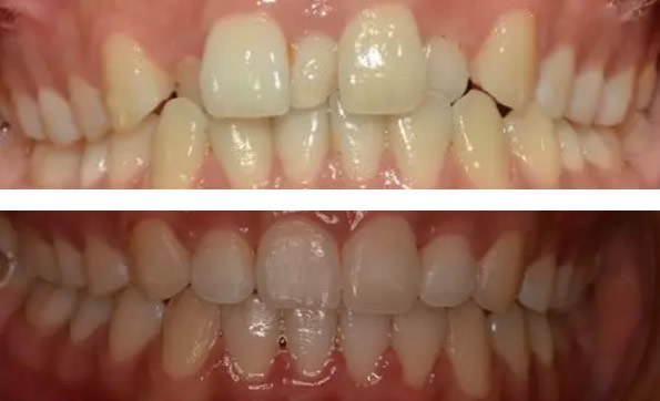 多生牙要拔嗎？看39歲白女士在武漢清華陽(yáng)光口腔的正畸經(jīng)歷