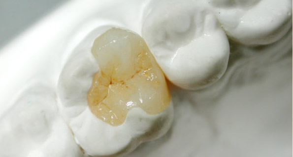 牙齒壞了怎么辦 嵌體修復和補牙哪個好 嵌體修復優(yōu)缺點大全