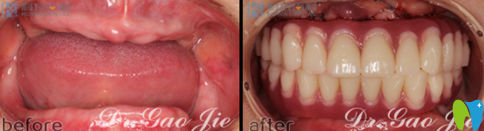 杭州科瓦齒科高杰全口牙種植案例圖