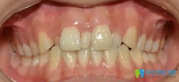 武漢清華陽(yáng)光口腔金屬托槽矯正牙齒前