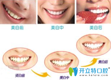 皓齒美白牙齒多少錢？解析步驟及優(yōu)缺點