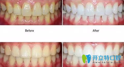 杭州科瓦齒科牙齒美白效果圖 杭州科瓦齒科牙齒美白效果圖