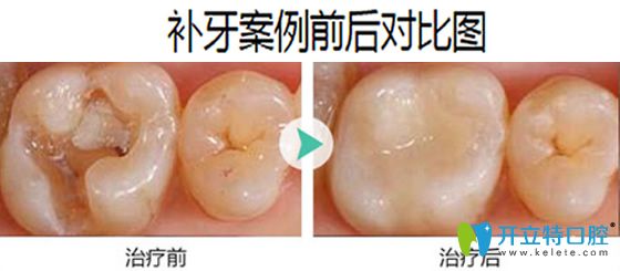 成都拜博口腔補(bǔ)牙案例前后對(duì)比圖