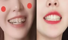 牙套剛畢業(yè)，分享我在成都拜博口腔矯正牙齒11個月來的體驗