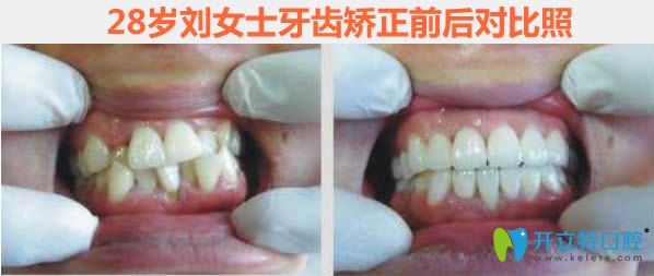 杭州蕭山至恒成年人牙齒矯正前后對比效果