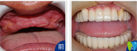 于鵬醫(yī)生全口牙缺失種植效果 于鵬醫(yī)生全口牙缺失種植效果