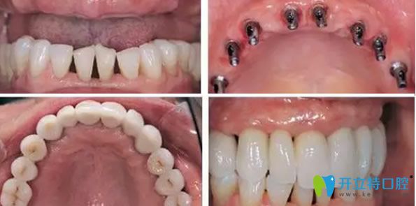 美奧口腔微創(chuàng)種植牙案例 美奧口腔微創(chuàng)種植牙案例