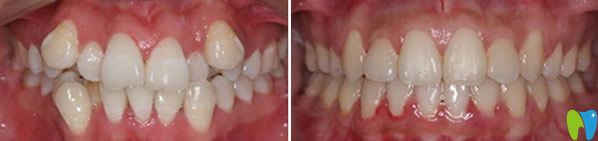 美奧口腔段婷牙齒矯正案例 美奧口腔段婷牙齒矯正案例