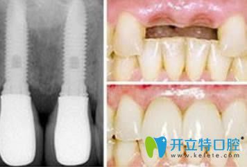 成都格林口腔<!--<i data=20240703-sp></i>-->忠院長種植牙案例圖 成都格林口腔<!--<i data=20240703-sp></i>-->忠院長種植牙案例圖