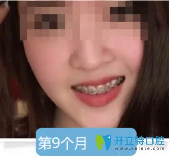 成年人的我佩戴牙套第9個月的效果
