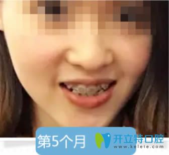 金屬托槽牙齒矯正5個月