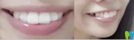 成都格林口腔牙齒正畸怎么樣?看我分享的齙牙矯正后效果