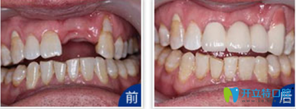 天津拜博口腔門牙缺失種植效果 天津拜博口腔門牙缺失種植效果