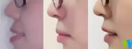 成都格林口腔門診隱適美牙齒正畸側(cè)面對(duì)比圖 成都格林口腔門診隱適美牙齒正畸側(cè)面對(duì)比圖