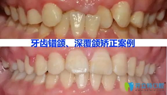 利爾口腔瀏陽分院牙齒錯頜畸形矯正效果