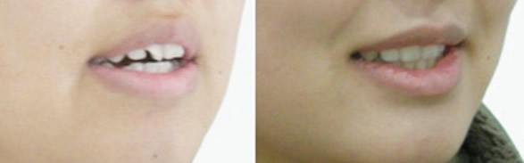 小孩齙牙怎么辦 我孩子在長(zhǎng)沙優(yōu)伢仕口腔正畸案例可以參考