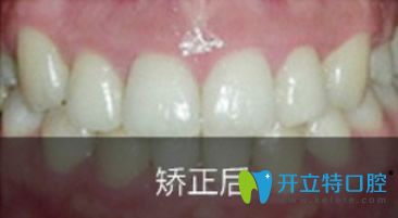 優(yōu)伢仕口腔矯正牙齒18個月效果
