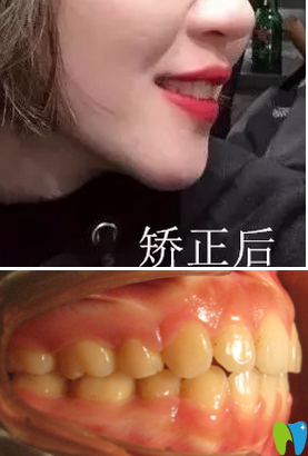 我在廈門登特口腔做牙齒矯正一年后效果