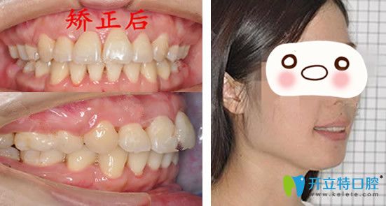 圣貝口腔熊飛牙齒矯正第902天效果圖展示 圣貝口腔熊飛牙齒矯正第902天效果圖展示