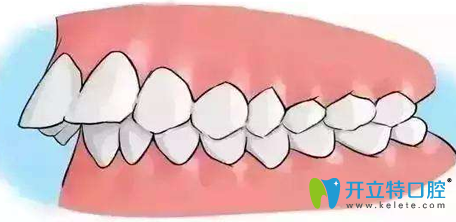 齙牙矯正多少錢要拔牙嗎，看廈門天使口腔矯正前后對(duì)比圖