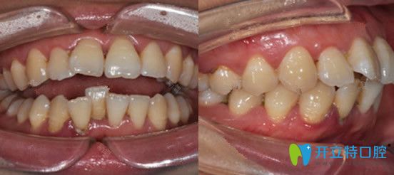 在廣州圣貝口腔矯正前牙齒情況 在廣州圣貝口腔矯正前牙齒情況