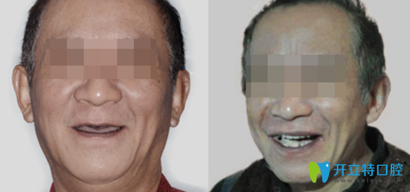 優(yōu)伢仕口腔蘭春祥醫(yī)生全口牙缺失種植效果