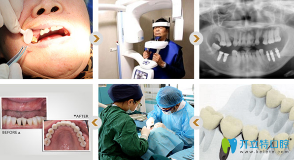 蘭春祥醫(yī)生種植牙的過(guò)程和效果