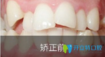 長沙優(yōu)伢仕口腔齙牙矯正前