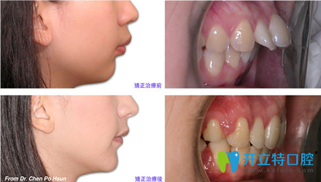 廈門天使口腔齙牙矯正前后對比圖