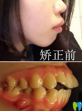 來(lái)看本人在廈門(mén)登特口腔做牙齒矯正減3200元費(fèi)用