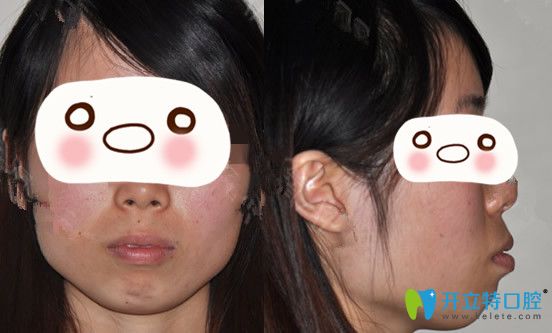 沒有找廣州圣貝口腔熊飛做正畸前的臉型照片 沒有找廣州圣貝口腔熊飛做正畸前的臉型照片