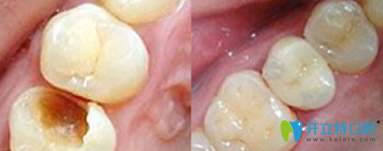 拜博口腔靠譜不？公布我的補(bǔ)牙治療前后對(duì)比圖