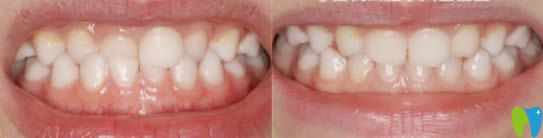 成都茁悅口腔李文星醫(yī)生兒童牙正畸效果對(duì)比圖 成都茁悅口腔李文星醫(yī)生兒童牙正畸效果對(duì)比圖