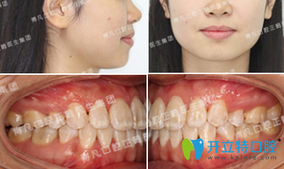 杭州博凡齒科盧海平給我做隱形牙齒矯正后照片