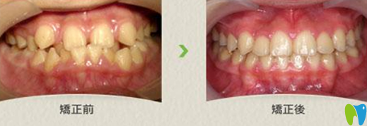 蒲濤牙齒矯正真人病例